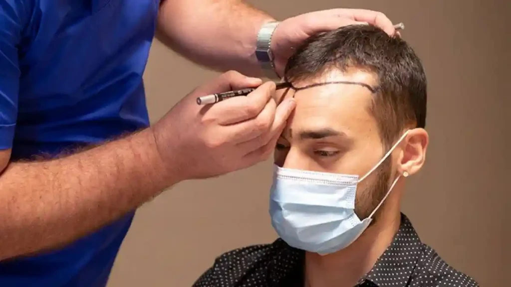 hair transplant in turkey for travelers